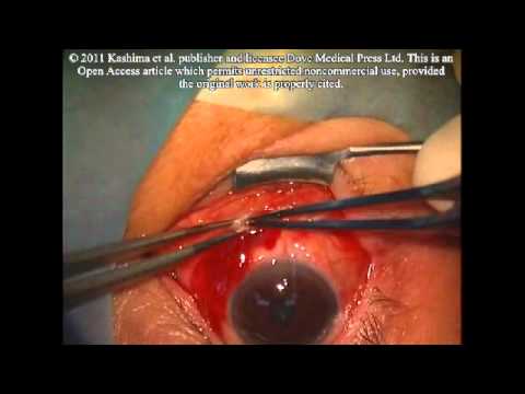 Understanding Conjunctivochalasis: Symptoms and Diagnosis