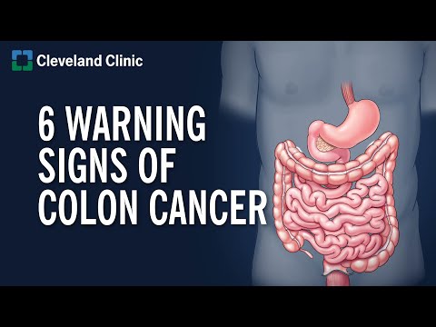 Recognizing Early Colorectal Cancer Symptoms in Both Genders