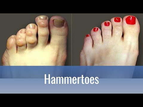 Understanding Hammertoe: Causes, Diagnosis, and Care Options