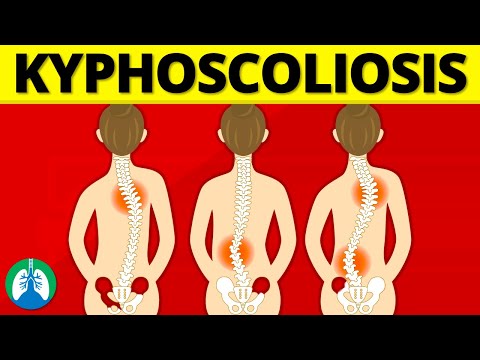 Understanding Kyphoscoliosis: Causes, Symptoms, and Care