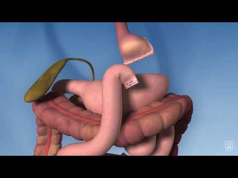 Bariatric Surgery: Key Steps for Success Before and After