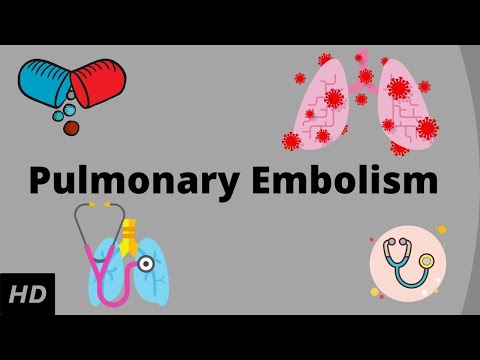 Understanding Treatments for Pulmonary Embolism: What to Know