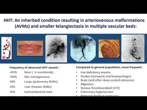 Understanding Osler-Weber-Rendu Disease: Key Causes and Symptoms