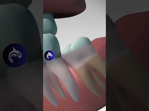 Understanding Wisdom Teeth: Their Role and Health Impact post thumbnail image