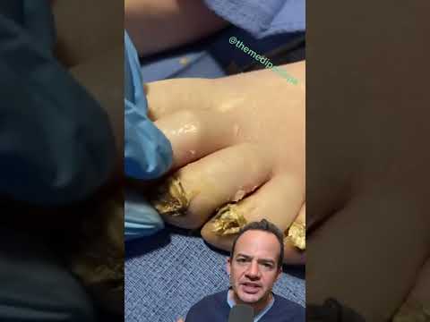 Understanding Skin Infections Around Your Fingernails and Toenails