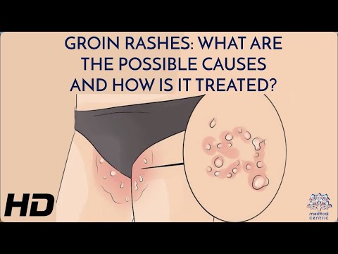 Understanding Inner Thigh Chafing: Causes and Effective Treatments