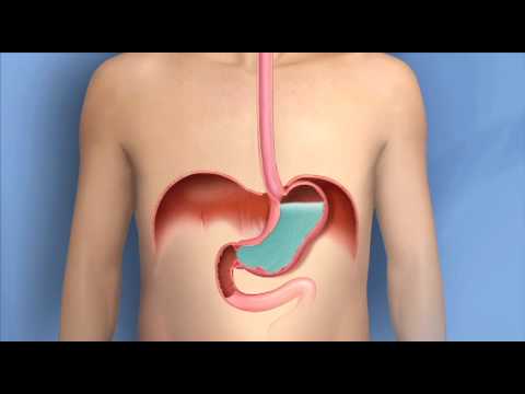 Understanding Water Brash: A Common GERD Symptom Explained