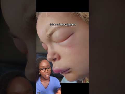 Understanding Treatment Options for Urticaria (Hives)