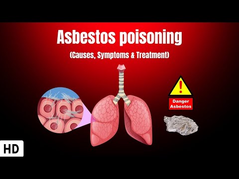 Understanding Asbestosis: Symptoms, Causes, and Treatment Options post thumbnail image