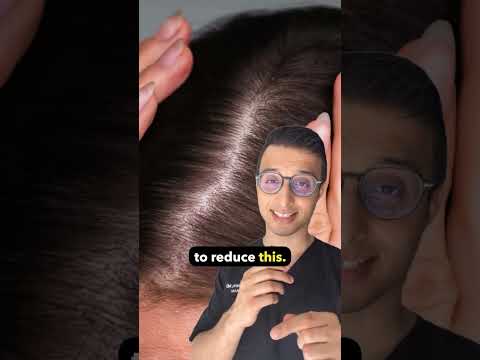 Understanding New FDA-Approved Treatments for Alopecia Areata