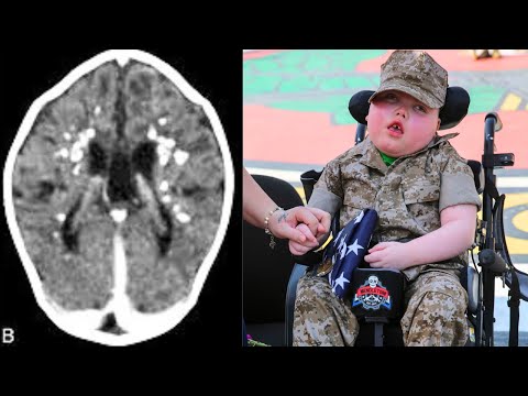 Understanding Aicardi Syndrome: Key Causes and Symptoms