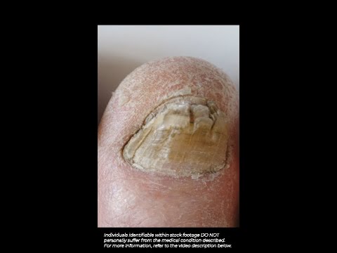Understanding Tinea Unguium: Symptoms, Causes, and Treatment