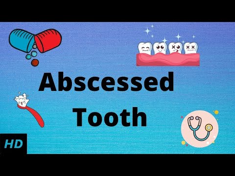 Understanding Dental Abscesses: Causes and Effects