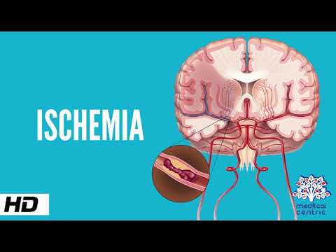 Understanding Microvascular Ischemic Disease: Key Symptoms Explained