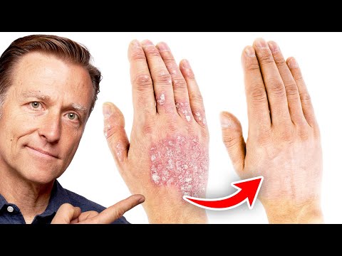 Effective Treatments for Eczema Blisters You Should Know