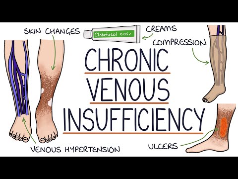 Understanding Venous Insufficiency: Causes and Signs