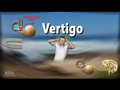 Understanding Vertigo: Causes, Symptoms, and Solutions