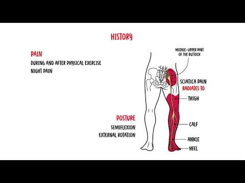 Understanding Piriformis Syndrome: Diagnosis and Controversies