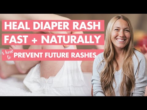 Treating Baby Yeast Infections: Diaper, Neck, and Mouth Care post thumbnail image