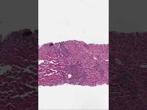 Understanding Autoimmune Hepatitis: A Hidden Challenge