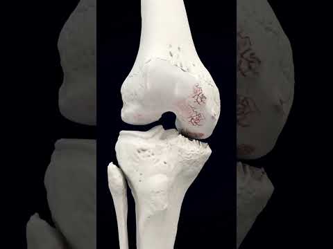 Relief at Last: Hyaluronan Injections for Knee Arthritis