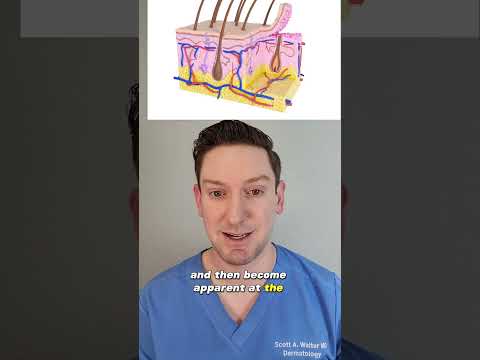 Papule Uncovered: How to Identify, Treat, and Prevent It