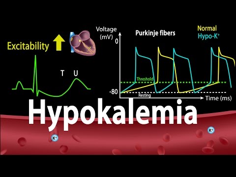 Understanding Hypokalemia: Symptoms, Causes, and Treatment