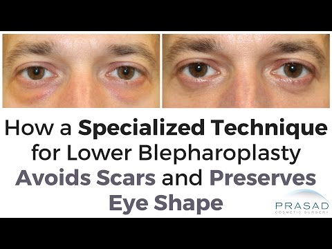 Understanding Eye Bag Surgery: Costs, Benefits, and Risks