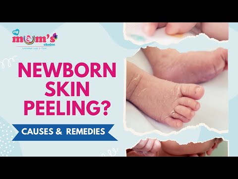 Understanding Your Newborn's Peeling Skin: Causes and Care