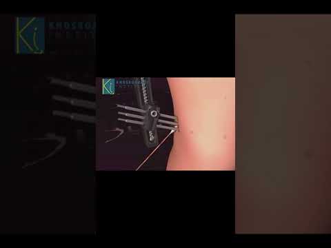 Understanding External Fixators: A Guide for Patients and Caregivers