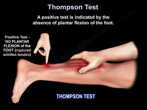 Understanding the Thompson Test for Torn Achilles Tendons post thumbnail image
