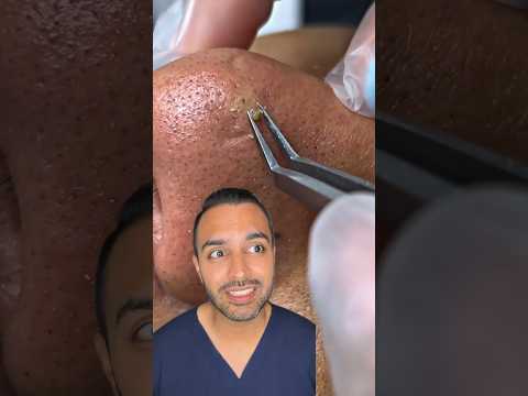Clearing Up the Confusion: Blackheads vs. Whiteheads