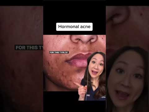 Managing Severe Acne: Key Strategies and Common Pitfalls