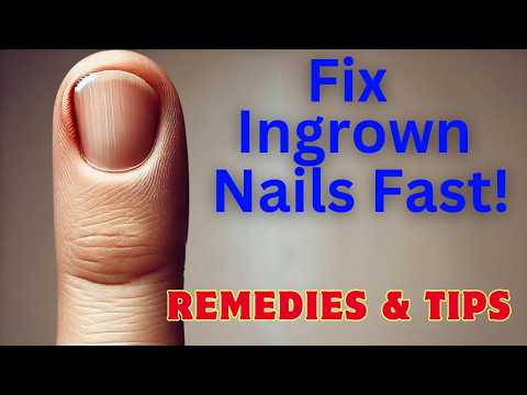 Simple Steps to Relieve an Ingrown Fingernail