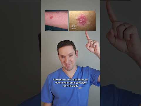 Recognizing Early Signs of Skin Cancer for Better Care