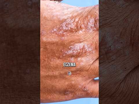 Soothing Solutions for Eczema: Home Remedies That Work