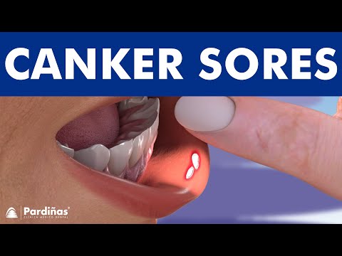 Canker Sores: What Triggers Them and How to Heal