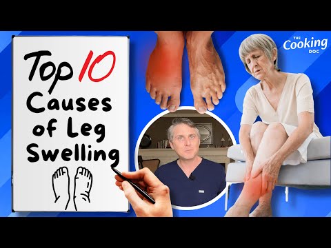 Understanding What Leads to Leg Swelling