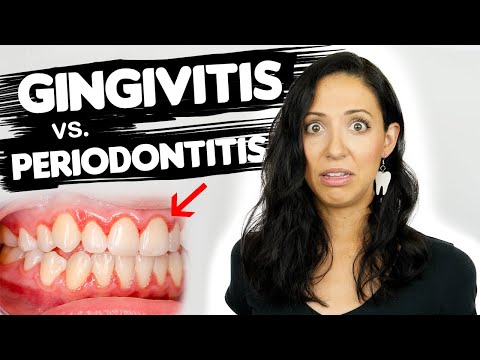 Understanding White Gums: Causes, Treatments, and Care