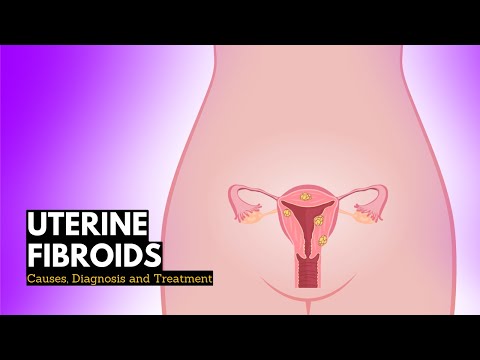 Understanding Myoma: Symptoms, Causes, and Effective Treatments post thumbnail image