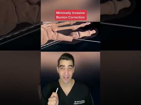 Do Bunion Correctors Really Alleviate Pain and Realign Toes?