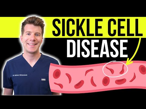 Understanding Sickle Cell Anemia: Can It Affect White Individuals? post thumbnail image