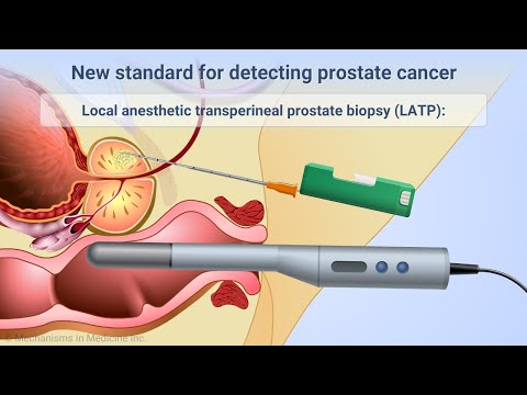 What Happens During a Prostate Biopsy?