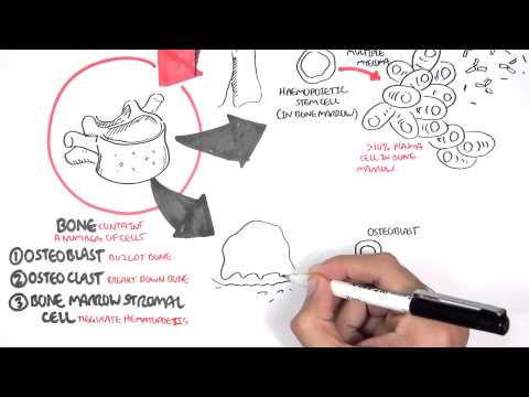 Understanding Lytic Bone Lesions in Multiple Myeloma Patients