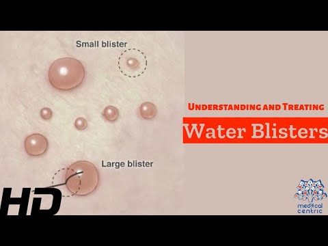 Understanding Blister Causes and Effective Treatments post thumbnail image