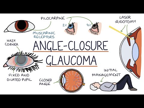 Understanding Closed-Angle Glaucoma: Symptoms and Treatments post thumbnail image