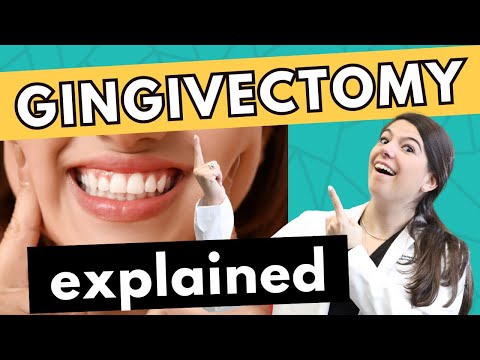 Gingivectomy: Recovery, Costs, and What Lies Ahead
