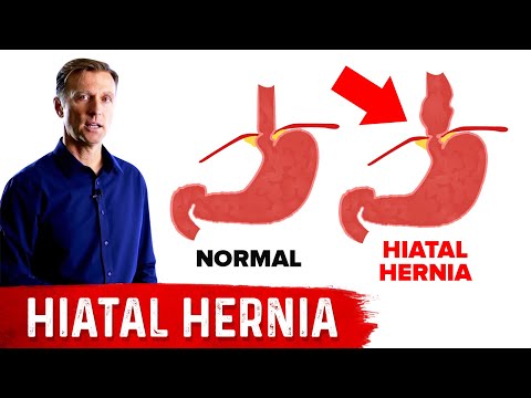 Simple Ways to Relieve a Hiatal Hernia at Home post thumbnail image
