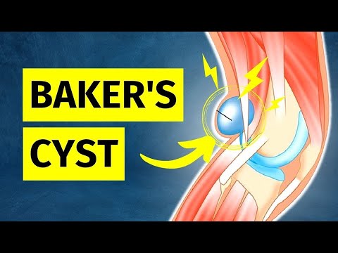 Understanding Meniscal Cysts: Symptoms, Causes, and Care