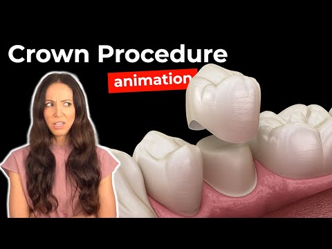 Dental Crowns: What You Should Know About Their Role and Care